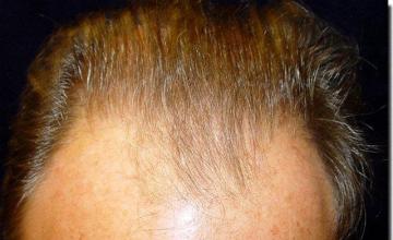 Hair restoration procedure results