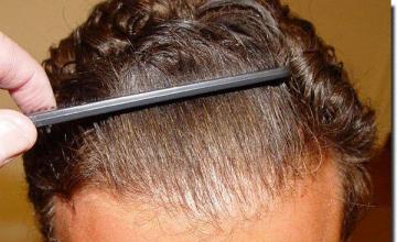 Hair restoration procedure results