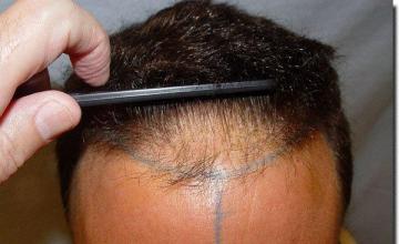 Hair restoration procedure results