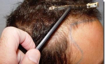 Hair restoration procedure results