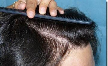 Hair restoration procedure results