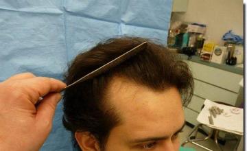 Hair restoration procedure results