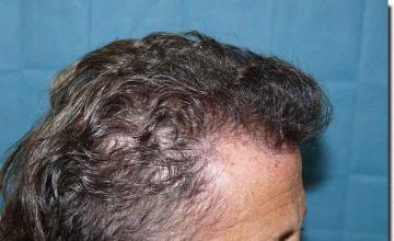 Hair restoration procedure results