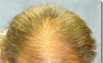 Hair restoration procedure results