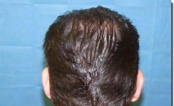 Hair restoration procedure results