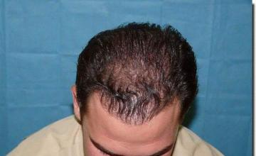 Hair restoration procedure results