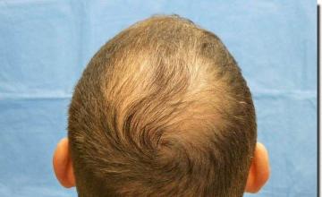 Hair restoration procedure results