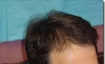 Hair restoration procedure results