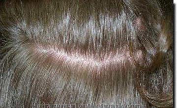 Hair restoration procedure results