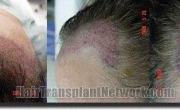 Hair restoration procedure results