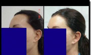 Hair restoration procedure results