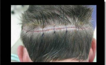 Hair restoration procedure results