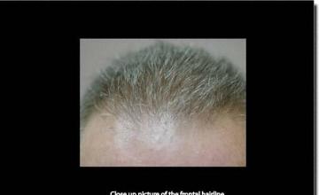 Hair restoration procedure results