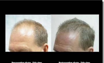 Hair restoration procedure results