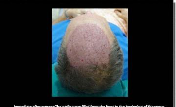 Hair restoration procedure results