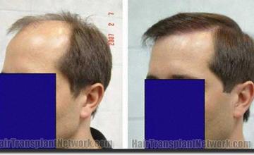 Hair restoration procedure results