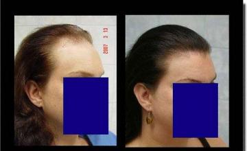 Hair restoration procedure results