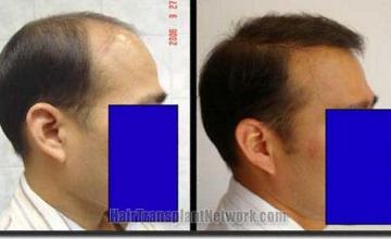 Hair restoration procedure results