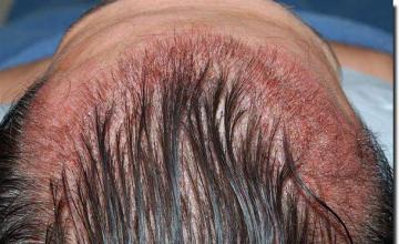 Hair restoration procedure results