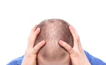 Hair loss Myths - What is or isn’t true?