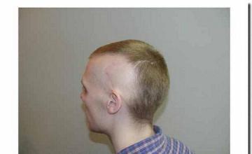 Hair restoration procedure results