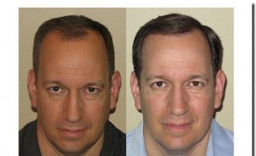 Hair restoration procedure results