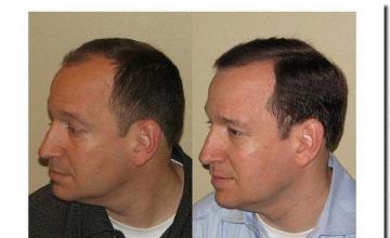 Hair restoration procedure results