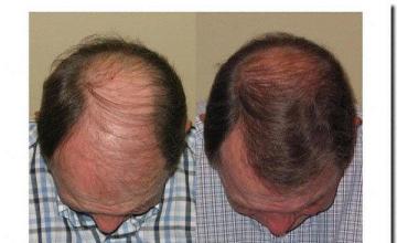 Hair restoration procedure results