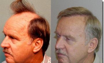 Hair restoration procedure results