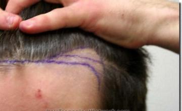 Hair restoration procedure results