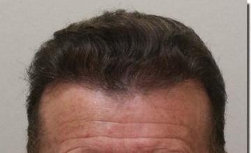 Hair restoration procedure results