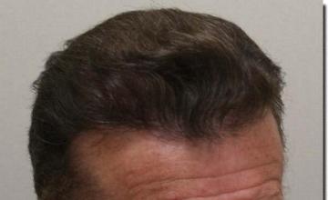 Hair restoration procedure results