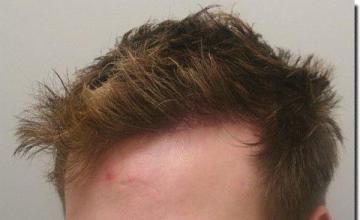 Hair restoration procedure results