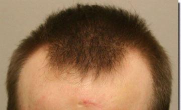 Hair restoration procedure results