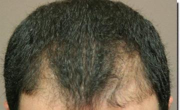 Hair restoration procedure results