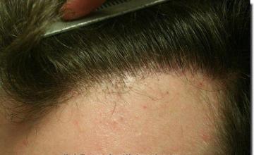 Hair restoration procedure results