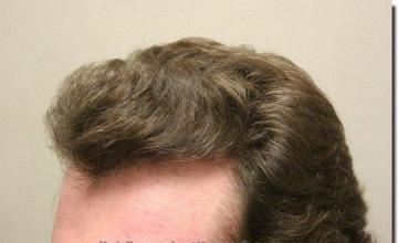 Hair restoration procedure results