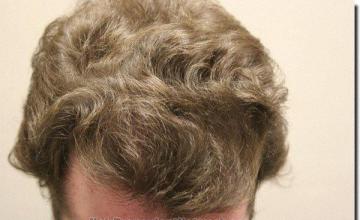 Hair restoration procedure results