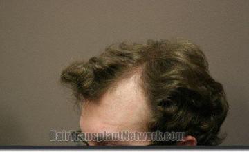 Hair restoration procedure results