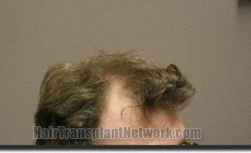 Hair restoration procedure results