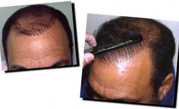 Hair restoration procedure results