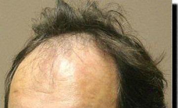 Hair restoration procedure results