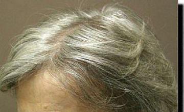 Hair restoration procedure results