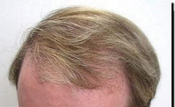 Hair restoration procedure results