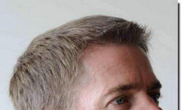 Hair restoration procedure results