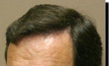 Hair restoration procedure results