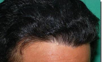 Hair restoration procedure results