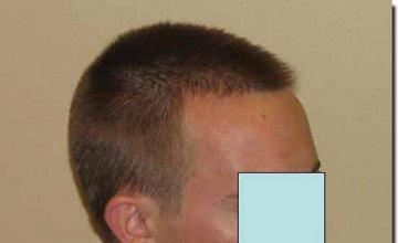 Hair restoration procedure results