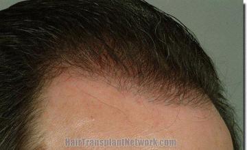 Hair restoration procedure results