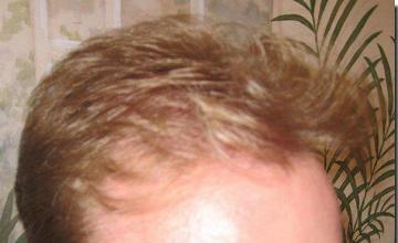 Hair restoration procedure results